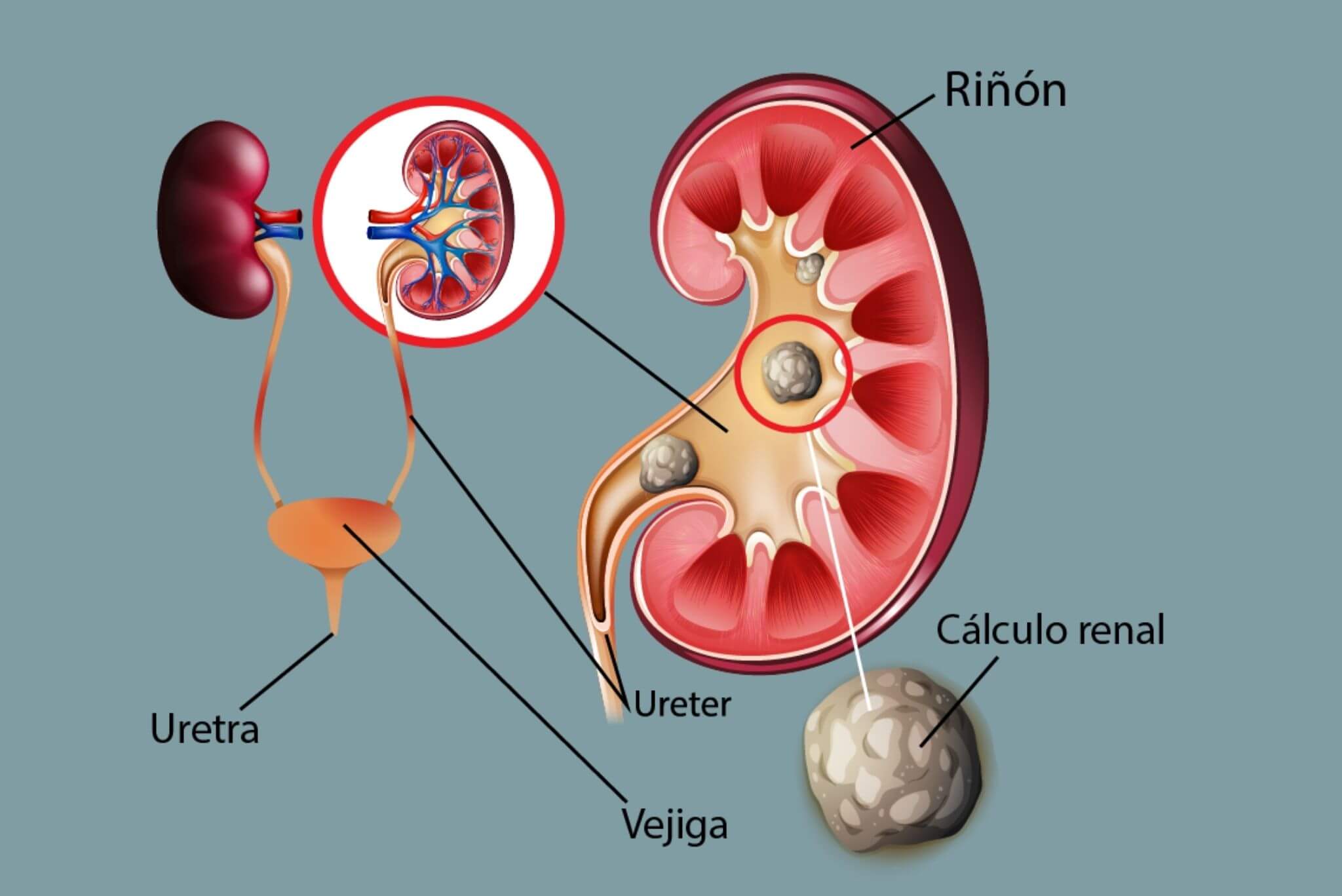 piedras-riñones